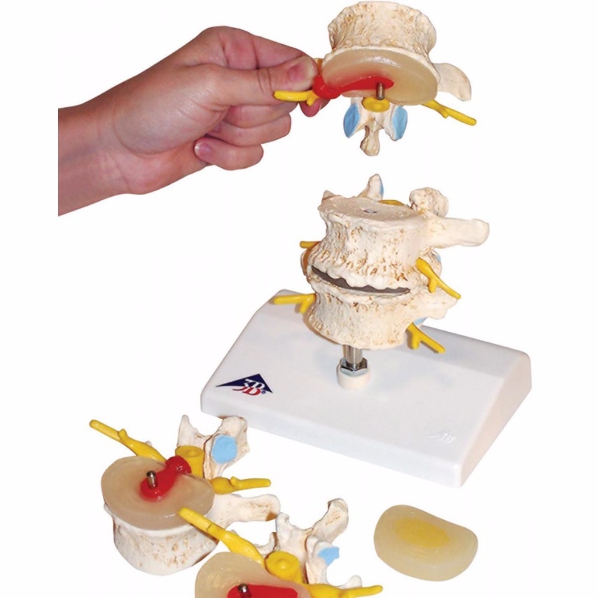 Stages-of-disc-prolapse-and-vertebral-degeneration 2  Thumbnail0