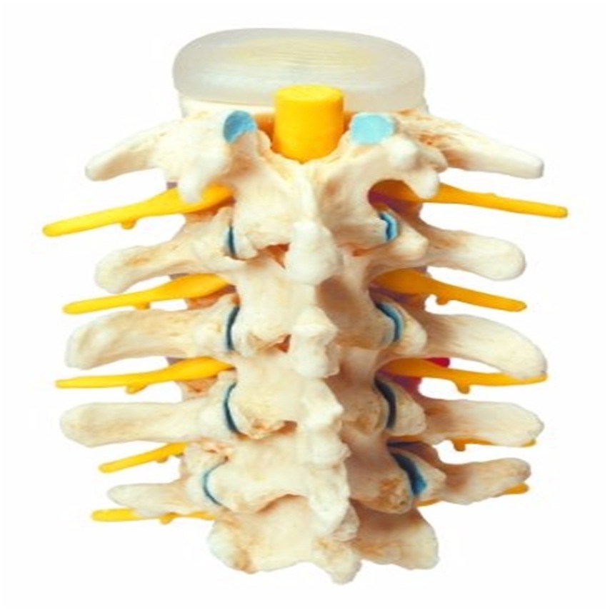 Stages-of-disc-prolapse-and-vertebral-degeneration 3  Thumbnail0