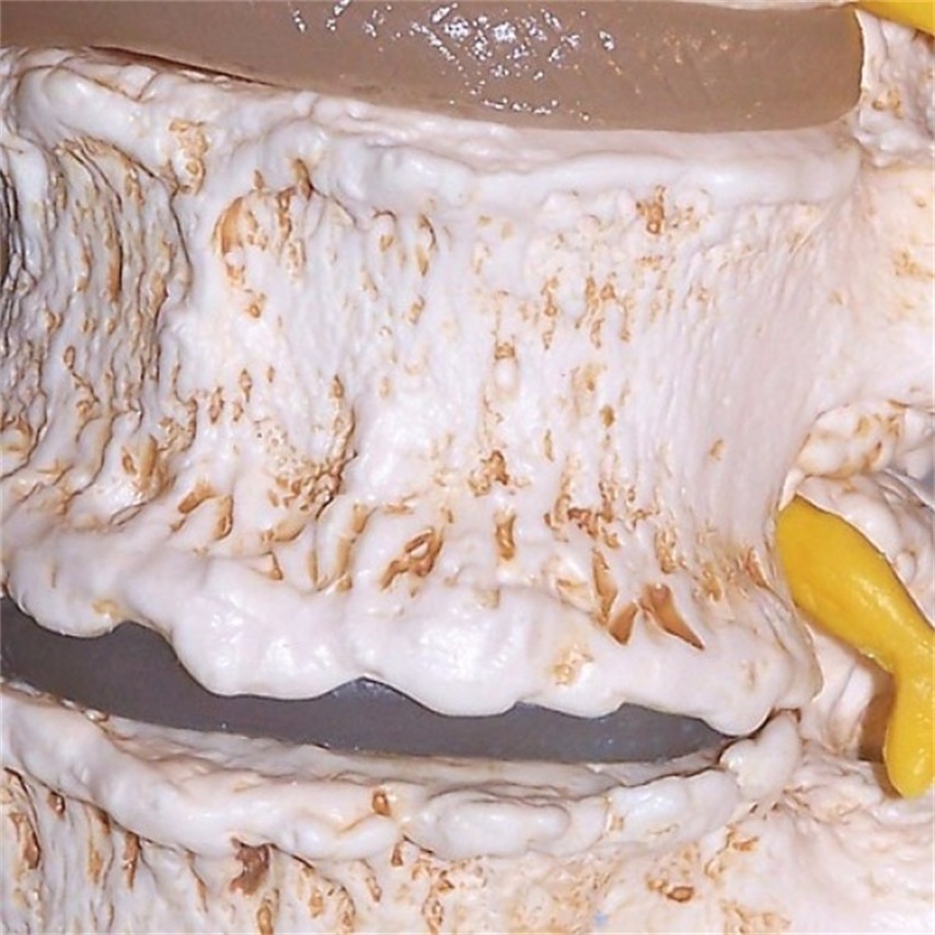 Stages-of-disc-prolapse-and-vertebral-degeneration 4  Thumbnail0